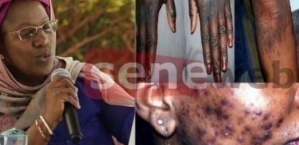 Dépigmentation au Sénégal : l’inquiétante révélation d’une dermatologue