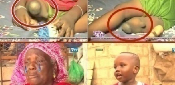 Triste histoire de Bébé Mouhamed (3ans) né avec une seule jambe