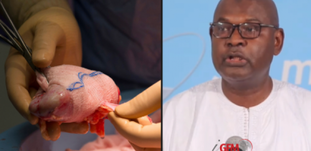 Transplantation rénale au Sénégal : Le dispositif pour éviter tout trafic d’organes !
