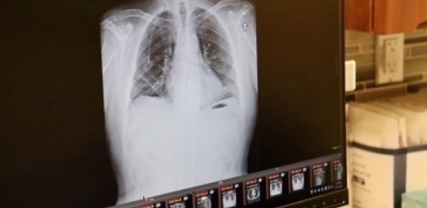 Un homme atteint d'un cancer terminal des poumons sauvé aux Etats-Unis par une double greffe