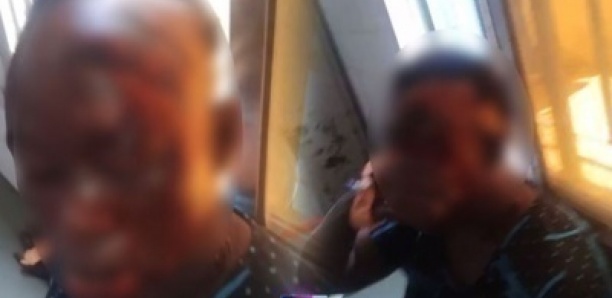MBACKÉ – Affaire de la femme ébouillantée à l’acide / La présumée coupable livrée à la gendarmerie par l’époux de la victime, par ailleurs son frère