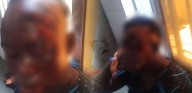 MBACKÉ – Attaque à l’acide : une femme grièvement blessée par la sœur de son époux… La présumée coupable en fuite