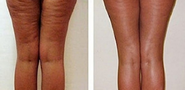 Comment se débarrasser de la cellulite adipeuse en ... Comment se débarrasser de la cellulite adipeuse en ...