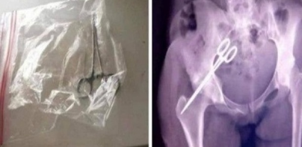 Sierra Leone : une paire de ciseaux oubliée dans le ventre femme retirée après 7 ans