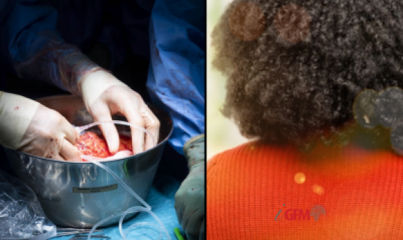 Transplantation Au Sénégal : Le Récit Inédit De Astou Qui A Donné Un Rein Pour Sauver Sa Soeur !